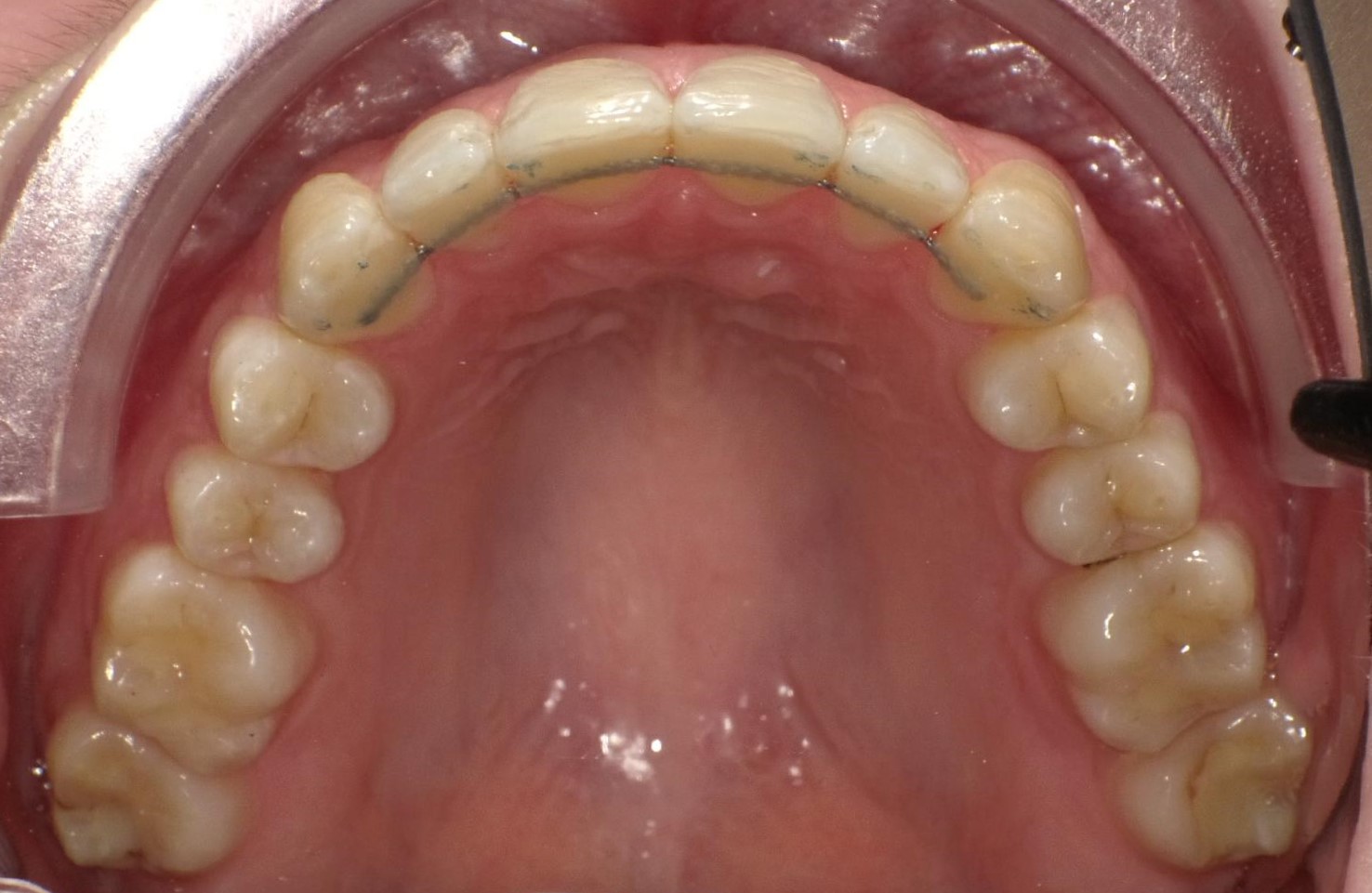 Odenwald Smile | Retainer